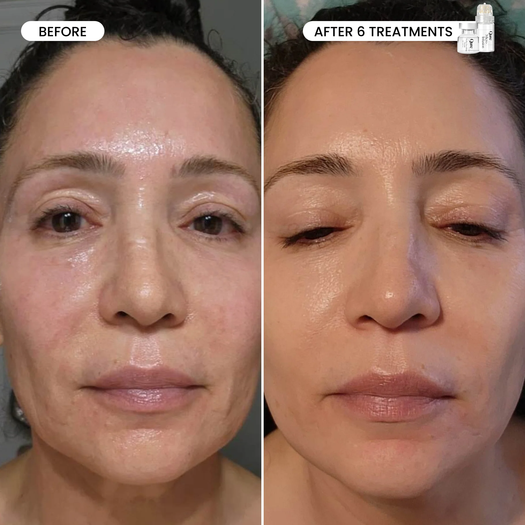 Micro-Infusion 1 Month Bundle (For Wrinkles) - Image 9