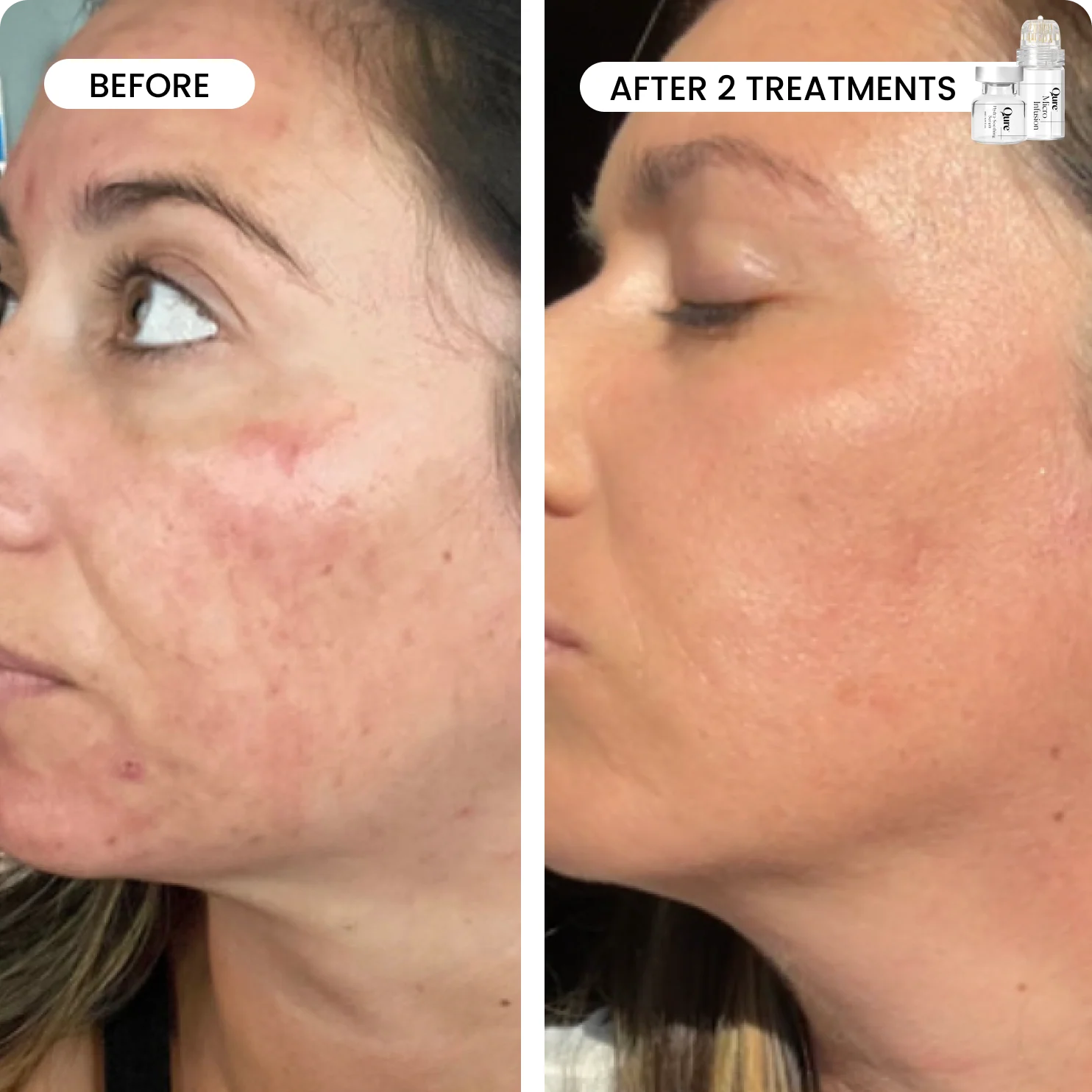Micro-Infusion 3 Month Bundle (For Dark Spots) - Image 3